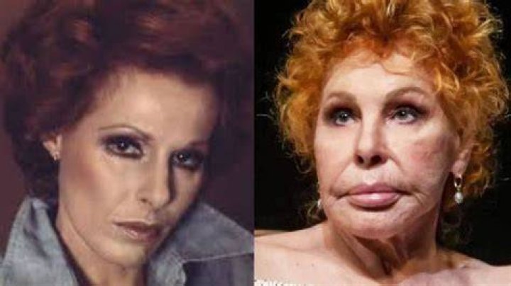 Ornella Vanoni Plastic Surgery Transformation Over The Years