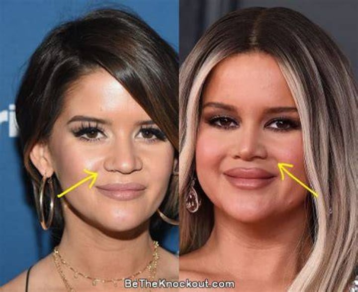 What Happened To Maren Morris Lips? Plastic Surgery Update, Before & After Photos From Instagram
