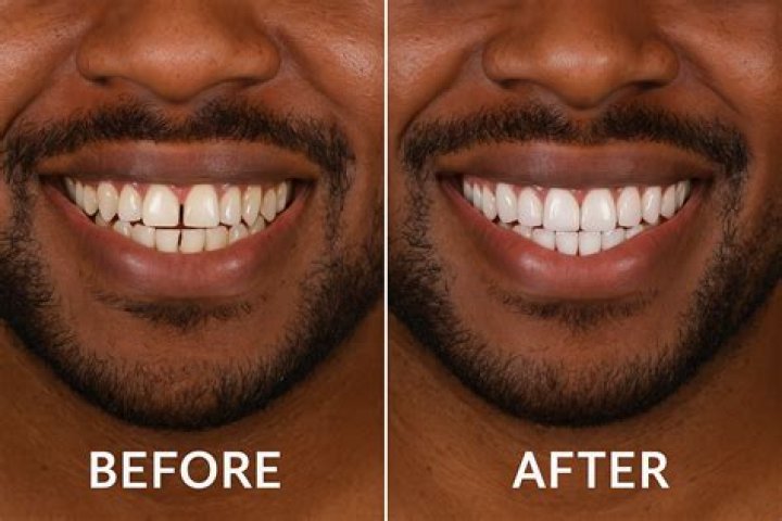 What Happened To Sha GZ Teeth | Before And After Photos